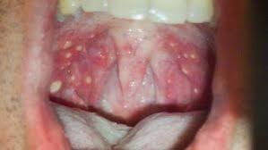 Image result for oral thrush symptoms roof of the mouth