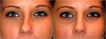 Crooked To Straight In Minutes Non Surgical Nose Job Nose Reshaping Nose Job Nose