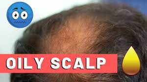 After five minutes, rinse it off and lastly, wash the hair with the help of a mild shampoo. Oily Scalp Treatment For Hair Loss The Best Way Youtube