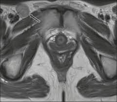 What are cancer symptoms and signs? Scielo Brasil State Of The Art In Vulvar Cancer Imaging State Of The Art In Vulvar Cancer Imaging