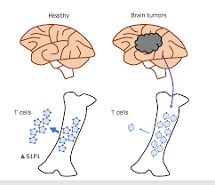 First of all, the type of brain cancer increased by cell phones is glioblastomas. Brain Cancer Potentially Resists Immunotherapies By Trapping T Cells In Bone Marrow Resou