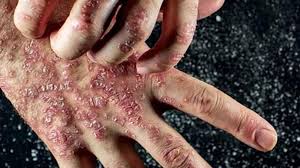 Autoimmune-Diseases-Causes-Symptoms-Diagnosis-Best-Treatment-Homeopathic-Allopathic-Conventional-Dr-Qaisar-Ahmed-Risalpur-Pakistan