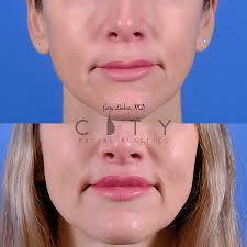 Does lip lift always change the nose shape? : r/PlasticSurgery