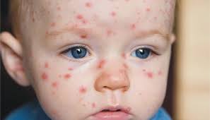 مرض الجدري أسبابه وأعراضه وطرق الوقاية