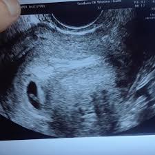 This is the time of the first missed period, when most women do not stop taking any prescribed medicine without checking with your doctor or midwife first. Ultrasound 5 Weeks 6 Days The Bump