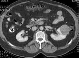 Causes of kidney cancer the cause of kidney cancer is unknown. Renal Cell Carcinoma Practice Essentials Background Pathophysiology