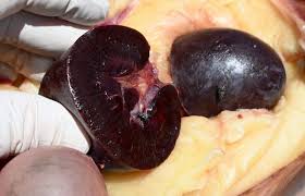 Image result for Copper Poisoning