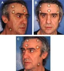 Computerized Navigation for Minimal Invasive Retrieval of Displaced Dental  Implants in the Lower Jaw