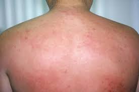 Image result for sweat rash on back baby