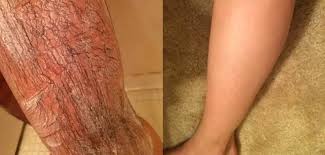 Then, work the device in short strokes to remove dead skin and peach fuzz. 23 Hair Removal Products That People Actually Swear By