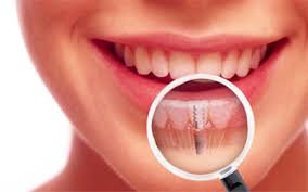Pembuatan gigi tiruan lengkap adalah bertujuan agar pasien dapat merasa nyaman kata kunci: Harga Gigi Tiruan Dental Id