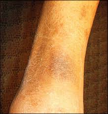 Image result for Diffuse Hyperpigmentation