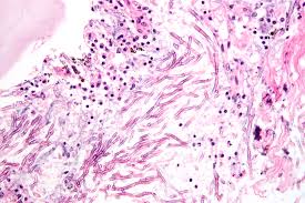Most affect the lungs and cause breathing difficulties. Datei Pulmonary Aspergillosis Jpg Wikipedia