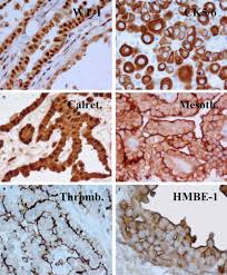 Mesothelioma is a type of cancer that develops from the thin layer of tissue that covers. Evaluation Of 12 Antibodies For Distinguishing Epithelioid Mesothelioma From Adenocarcinoma Identification Of A Three Antibody Immunohistochemical Panel With Maximal Sensitivity And Specificity Modern Pathology