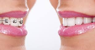 They will be advised to go on using the retainer indefinitely during the night. Life After Braces What You Should Know About Retainers Wear And Care