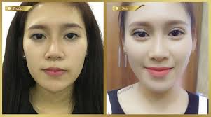 Cắt mí Mini Deep có để lại sẹo không?