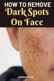 How To Get Rid Of Dark Spots Overnight With Home Remedies Trabeauli In 2020 Dark Spots On Face Spots On Face Remove Dark Spots