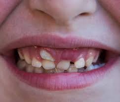 Why Does My Child Have Two Rows Of Teeth