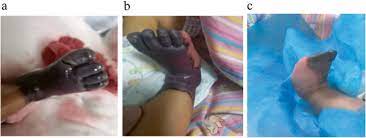 Given suspected ps deficiency as the cause of pf. Genotypic And Phenotypic Character Of Chinese Neonates With Congenital Protein C Deficiency A Case Report And Literature Review Thrombosis Journal Full Text
