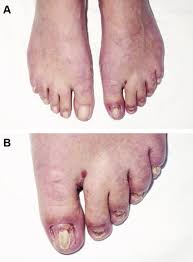 Image result for Onycholysis feet