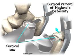 Best hospitals and doctors for haglund's syndrome treatment abroad. Haglund S Deformity 2020 Orthonorcal Los Gatos Capitola Morgan Hill Watsonville Ca