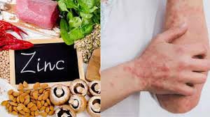 Image result for Zinc Deficiency