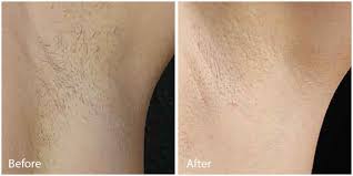 Things to follow after a session. Laser Hair Removal Miami Miami Beach Information Promotion