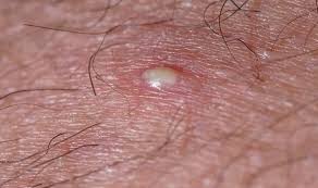 Keep reading to find out. How To Get Rid Of Ingrown Hairs Expert S Go To Exfoliating Treatment Express Co Uk