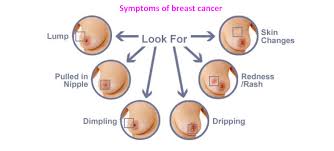There are five stages of breast cancer, ranging from 0 to iv. Breast Tumor Abanhospital