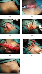 Image result for Inguinal hernia child