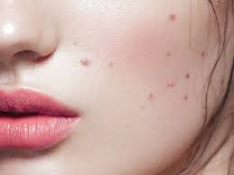 But, these seemingly harmless spots on the skin may be hiding a deadly disease: . The History Of Beauty Marks 11 Facts About Moles Allure