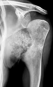Image result for Chondrosarcoma