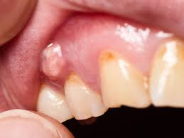 Image result for Periodontal Abscess