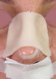 What is the mechanism ? answered by dr. Cast Falling Off After Rhinoplasty What Should I Do