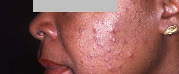 Inflammation of the skin membrane; Nodular Acne Ducray