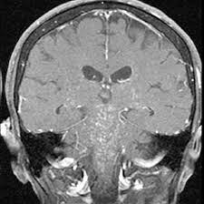 Our case is unique in that this is the first case which demonstrates involvement of the. Clippers An Increasingly Recognized Chronic Inflammatory Central Nervous System Disorder The American Journal Of Medicine