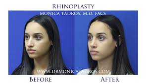 If you are considering rhinoplasty (a nose job), one of the first things you will need to determine is how you will pay for the procedure. How Much Does A Nose Job Cost In Nyc Job Retro