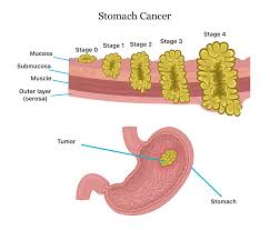 Lebih dari 95% kasus tumor ganas laring adalah karsinoma sel skuamosa. Stomach Cancer Symptoms Causes Stages Treatment And Survival Rates