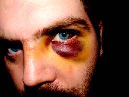 Pressure behind one eye (with pictures) 4 ways to lower pressure without drops wikihow. Pressure Behind My Eye Common Questions Eye Consultants