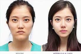 In south korea (hereafter “korea”) in particular, an increasing number of people have been undergoing cosmetic surgery. Before After Plastic Surgery In Korea Album On Imgur