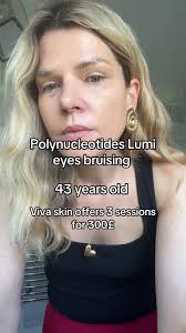 Polynucleotides Treatment at Viva Skin Clinics