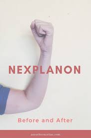 Nexplanon Before And After Nexplanon Birth Control Implant Nexplanon Implant