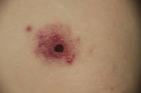 An infectious disease especially of wild rabbits, rodents, some domestic animals, and humans that is caused by a bacterium (francisella tularensis), is transmitted especially by the bites of insects. Tularaemia In Southwest Germany Three Cases Of Tick Borne Transmission Sciencedirect