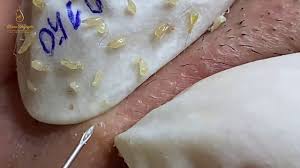 Soak a washcloth in warm water and press it against the ingrown hair (s) for several minutes. Blackheads Extractions And Ingrown Hairs 150 Loan Nguyen Youtube