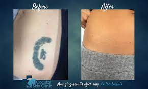 It can cause brief discomfort. Before After Tattoo Removal Sunshine Coast