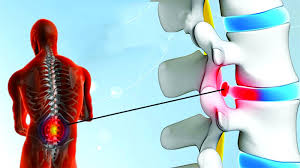 If the medical measures are not successful within a reasonable time (6 weeks or more), and the tests frequently, time and basic spine care resolve most slipped disc symptoms without the need for operation. How Much Cost For Slip Disc Surgery