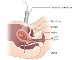 Image result for Chorionic Villus Sampling