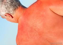 There are four main types of sun allergy: What Are The Signs Of A Sunscreen Allergy With Pictures