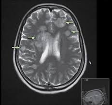 There are several different types of aspergillosis. Disseminated Aspergillosis In An Hiv Positive Cannabis User Taking Steroid Treatment The Lancet Infectious Diseases
