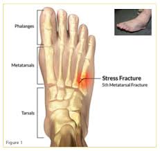 Specific types of metatarsal fracture include an avulsion fracture, where the tendon of the peroneus brevis muscle pulls a piece of the bone away. Jones Fracture Sports Clinic Nq